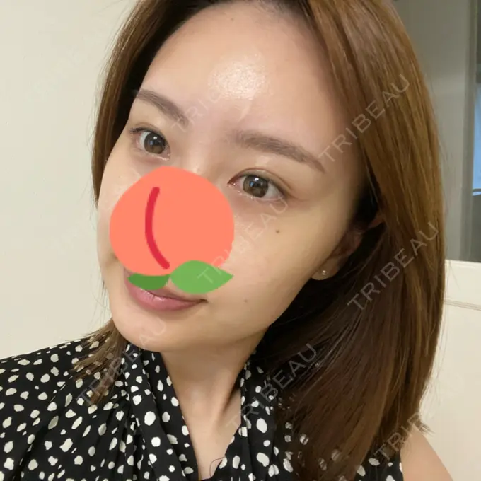 水光注射（ハリ・美肌） STARS CLINIC BEFORE メイン用