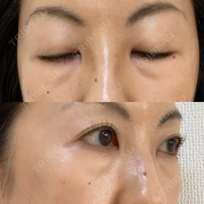 下まぶたたるみ取り 吉井クリニック BEFORE メイン用