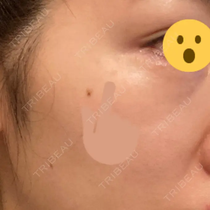 シミ取りレーザー 渋谷美容外科クリニック 渋谷院 BEFORE メイン用