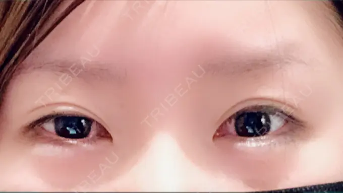 二重切開 / 眼瞼下垂（切開） / 目尻切開 / タレ目形成・グラマラスライン（切開） / 前額リフト レアート整形外科 BEFORE メイン用
