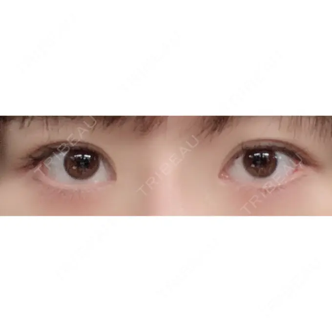 二重切開 / 眼瞼下垂（切開） / 上まぶたたるみ取り / 上まぶたの脂肪取り / 目元修正 / その他（目元） リビジョンクリニック（旧：池本形成外科・美容外科） BEFORE メイン用