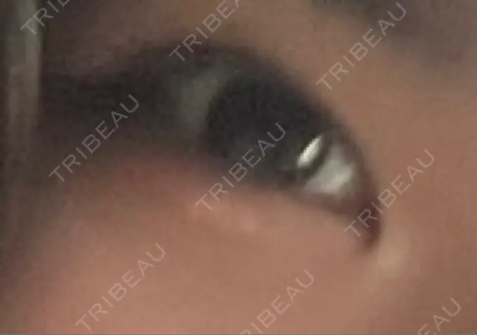 二重埋没 大塚美容形成外科 金沢院 BEFORE メイン用