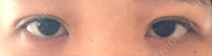 目頭切開 くさのたろうクリニック BEFORE メイン用