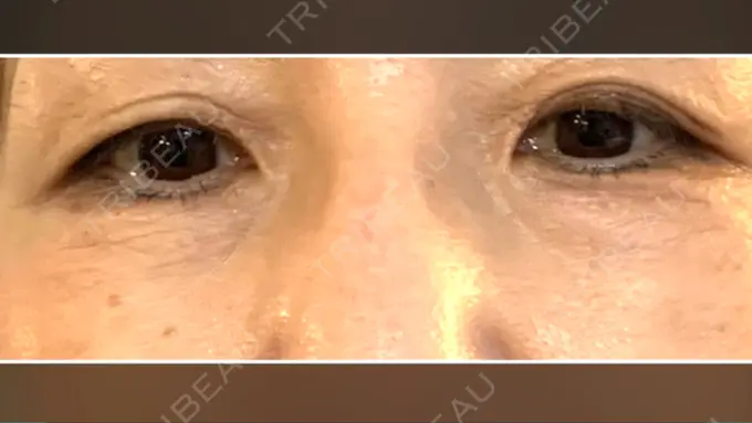 クマ治療 / 下まぶたたるみ取り / 脂肪注入（肌） 湘南美容クリニック 藤沢院 BEFORE メイン用