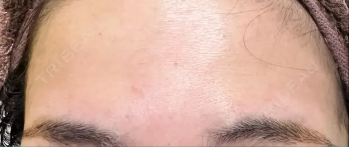 ボトックス（眉間） / ボトックス（額） / その他（鼻） TCB東京中央美容外科 郡山院 BEFORE メイン用