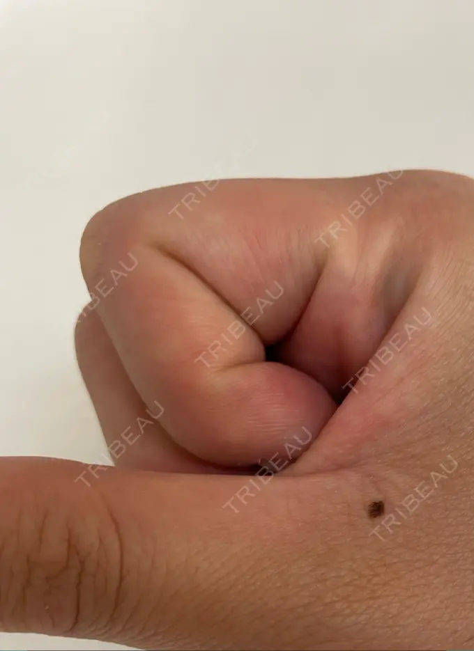 ほくろ・いぼ切除（肌） 吉祥寺アイビークリニック BEFORE メイン用