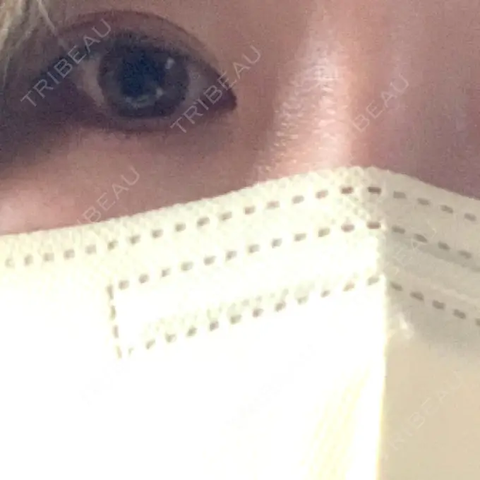 二重埋没 十仁美容整形 BEFORE メイン用