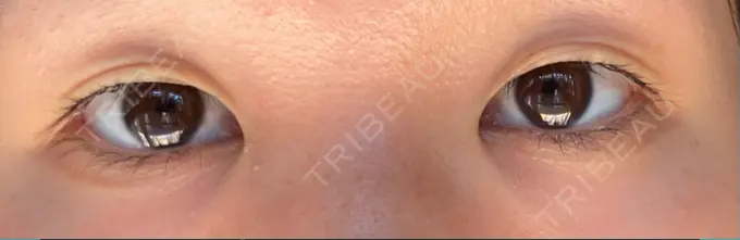 二重埋没 アマソラクリニック BEFORE メイン用