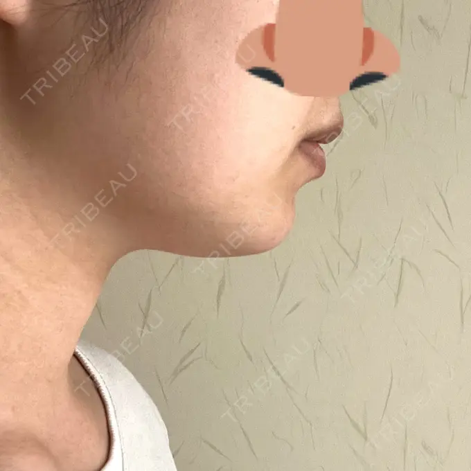 糸リフト / 脂肪吸引（顔） 東京シンデレラ美容外科 池袋院 BEFORE メイン用