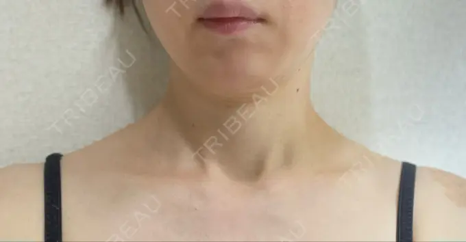 ボトックス（肩） BRIGHTS beauty clinic BEFORE メイン用