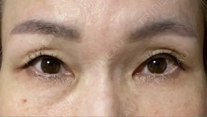 上まぶたたるみ取り 心斎橋形成外科スキンケアクリニック BEFORE メイン用