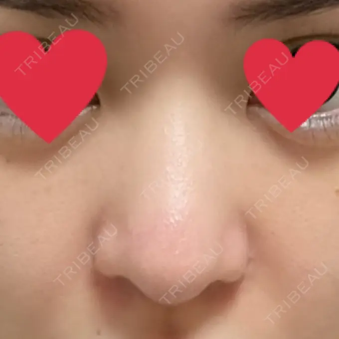 鼻中隔延長（切開） / 小鼻縮小（切開） / 脂肪吸引（お腹） / 軟骨移植 / 骨切幅寄せ / 鼻修正 / 鼻尖縮小 / 鼻翼基部形成（貴族手術） ヴェリテクリニック 大阪院 BEFORE メイン用