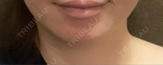 ハイフ（顔） 表参道メディカルクリニック 大阪院 BEFORE メイン用