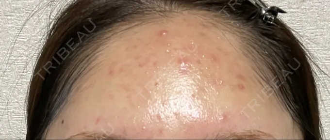 ピーリング（ニキビ・毛穴） / イオン導入 渋谷美容外科クリニック 横浜院 BEFORE メイン用