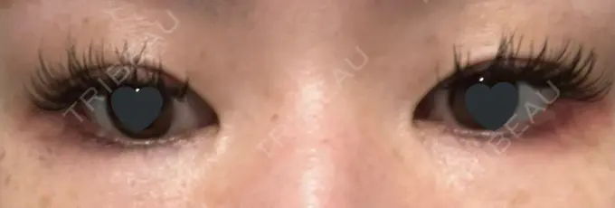 二重埋没 神戸元町ビューティークリニック BEFORE メイン用