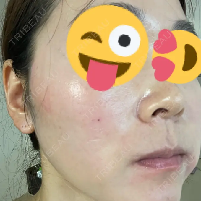 美肌レーザー まゆりなclinic 名古屋栄 BEFORE メイン用