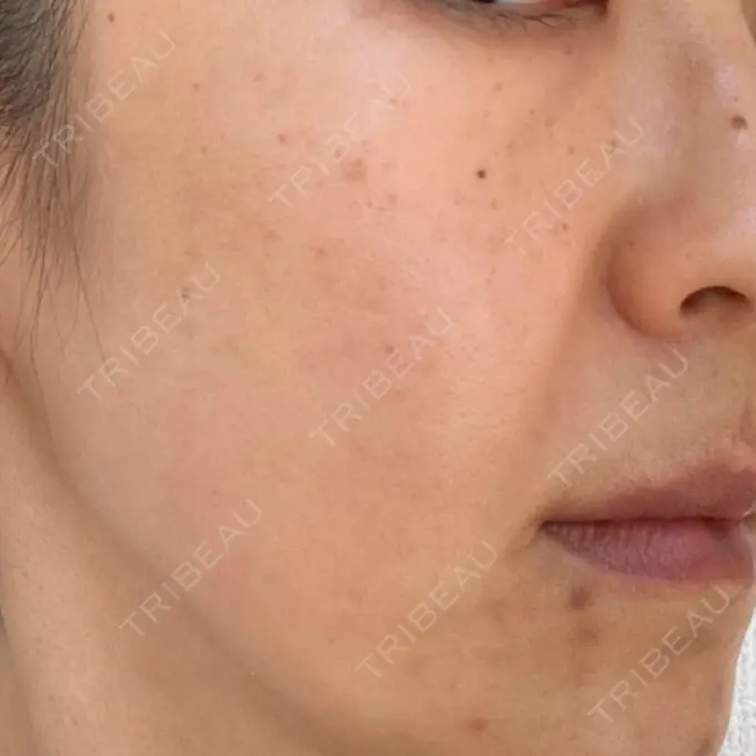 シミ取りレーザー 上本町皮フ科クリニック BEFORE メイン用