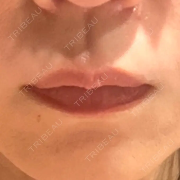 ボトックス（人中） veary clinic BEFORE メイン用