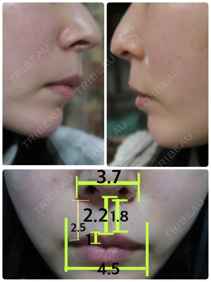 人中短縮 / 口角挙上 / その他（口元） グリム整形外科 BEFORE メイン用