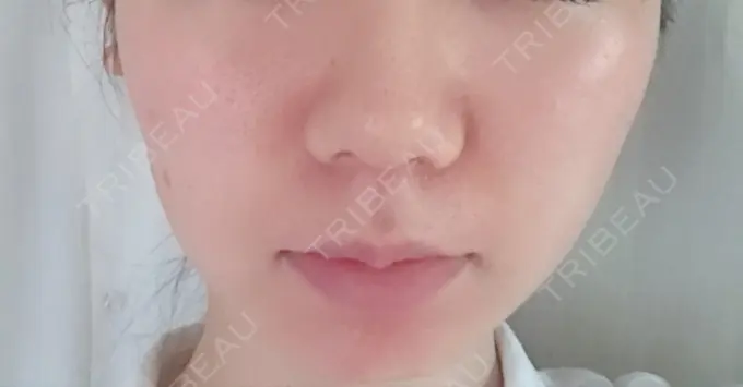 ハイフ（顔） メディアージュクリニック 青山院 BEFORE メイン用