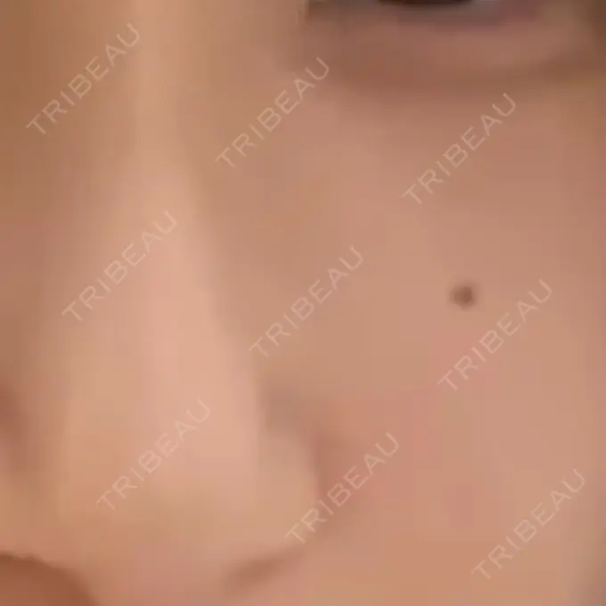 ほくろ・いぼ切除（肌） 吉祥寺アイビークリニック BEFORE メイン用