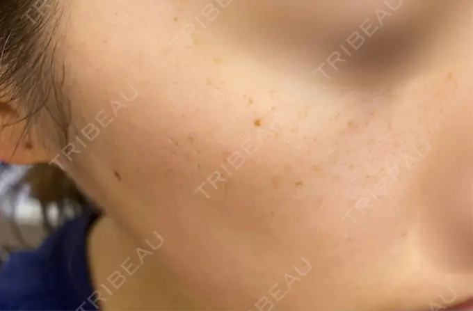 ピコスポット Fellez Clinic【フェルズクリニック】 BEFORE メイン用