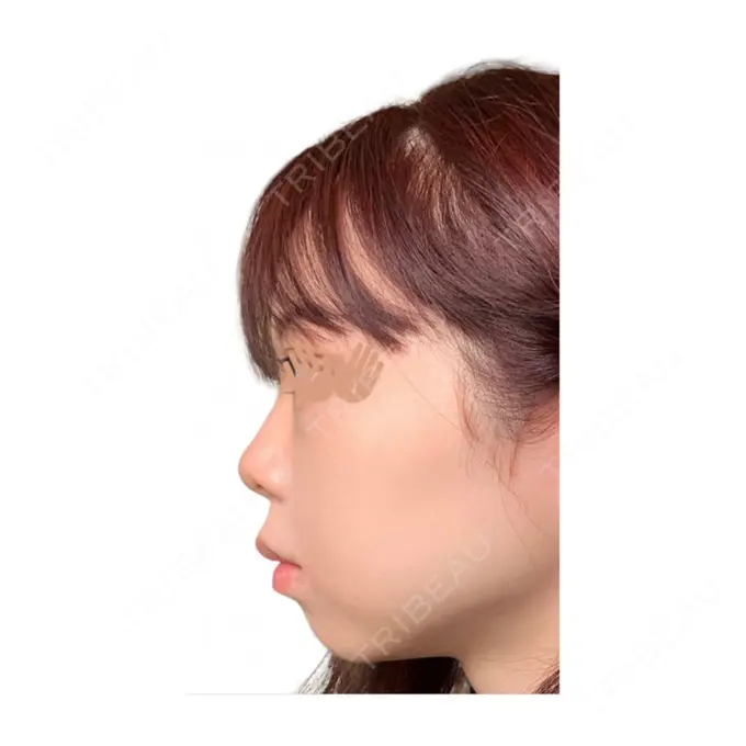 ヒアルロン酸注入（鼻） STARS CLINIC BEFORE メイン用