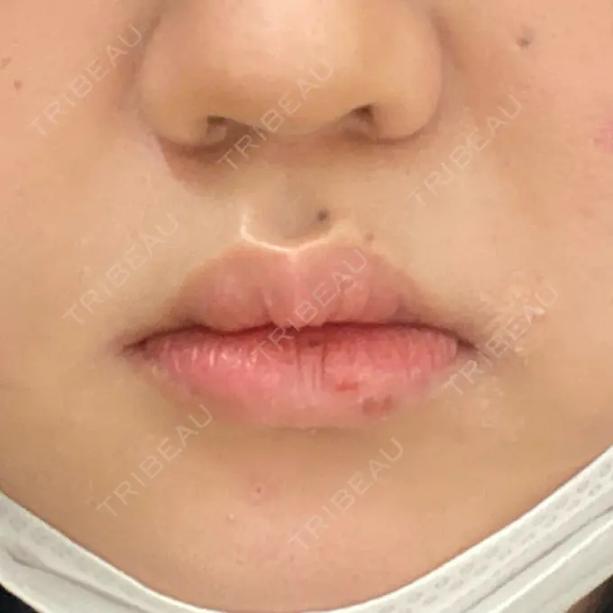 ヒアルロン酸注入（唇） / ボトックス（口角） フィラークリニック 町田院 BEFORE メイン用