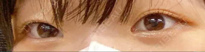 二重埋没 神戸元町ビューティークリニック BEFORE メイン用