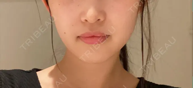 糸リフト / 脂肪吸引（顔） / ボトックス（エラ・小顔） HAAB×DREAM BEAUTY CLINIC 東京本院 BEFORE メイン用