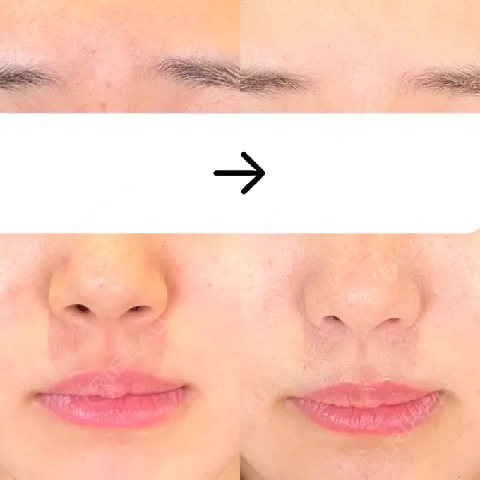 小鼻縮小（切開） SOL CLINIC BEFORE メイン用