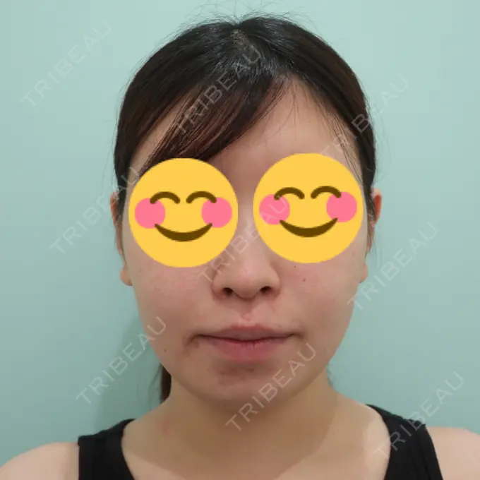 脂肪吸引（顔） / 脂肪冷却（輪郭） WOM CLINIC GINZA （ワム クリニック ギンザ） BEFORE メイン用