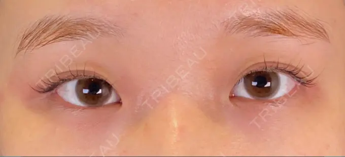 二重埋没 SOL CLINIC BEFORE メイン用