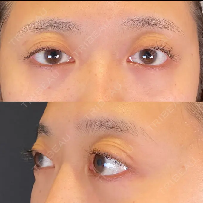 眼瞼下垂（非切開） SOL CLINIC BEFORE メイン用