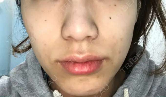 ほくろ・いぼ切除（肌） / 白玉点滴・注射 / プラセンタ注射 / その他（肌） / 美肌レーザー / ほくろ・いぼ除去レーザー（肌） / ニキビ治療 YOU&I皮膚科 明洞店 BEFORE メイン用