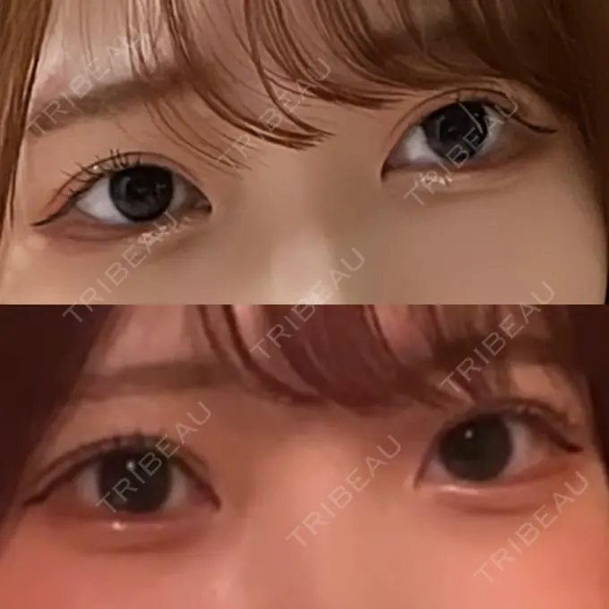 ヒアルロン酸注入（涙袋） 渋谷美容外科クリニック 渋谷院 BEFORE メイン用