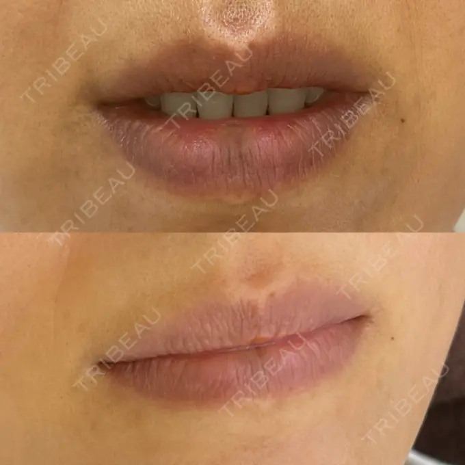 アートメイク（唇） エールクリニック 大阪心斎橋 BEFORE メイン用