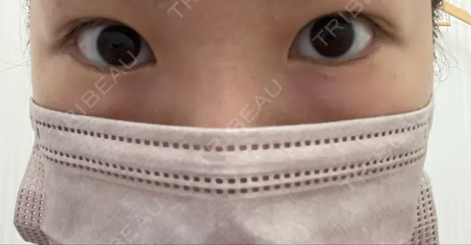 目尻切開 TCB東京中央美容外科 金沢院 BEFORE メイン用