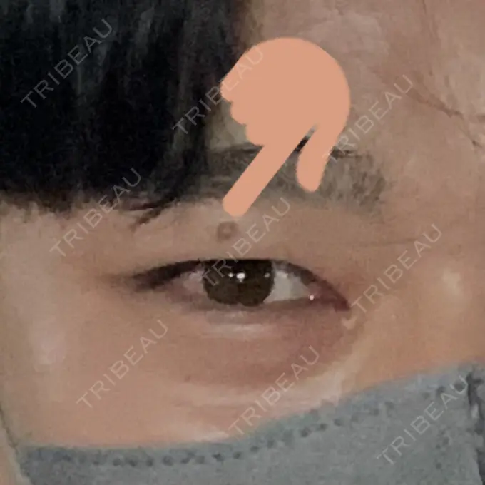 ほくろ・いぼ除去レーザー（肌） エースクリニック 大阪梅田HEPナビオ院 BEFORE メイン用