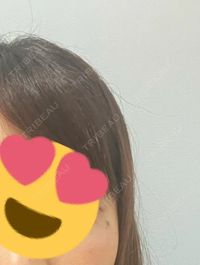 ほくろ・いぼ切除（肌） 吉祥寺アイビークリニック BEFORE メイン用