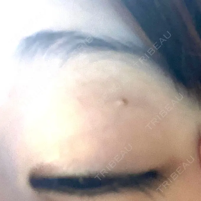 ほくろ・いぼ切除（肌） 吉祥寺アイビークリニック BEFORE メイン用