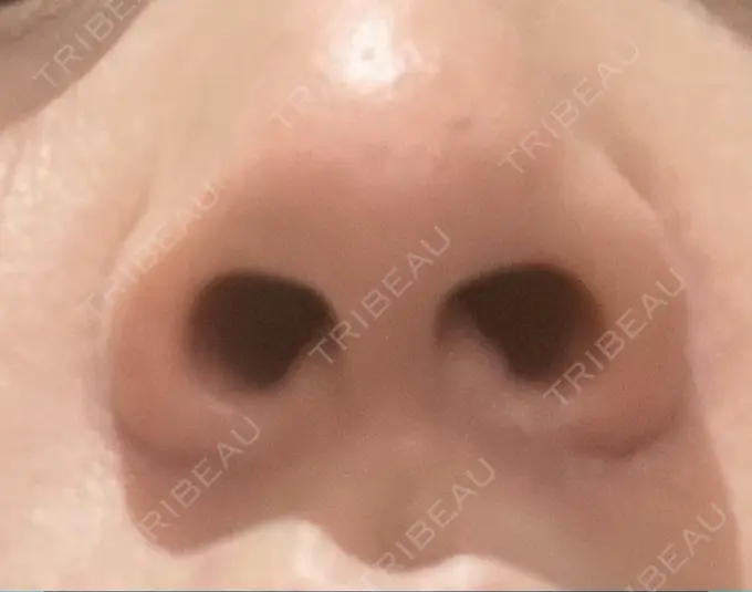 小鼻縮小（切開） / ヒアルロン酸注入（鼻） / ボトックス（エラ・小顔） / その他（鼻） 吉祥寺アイビークリニック BEFORE メイン用