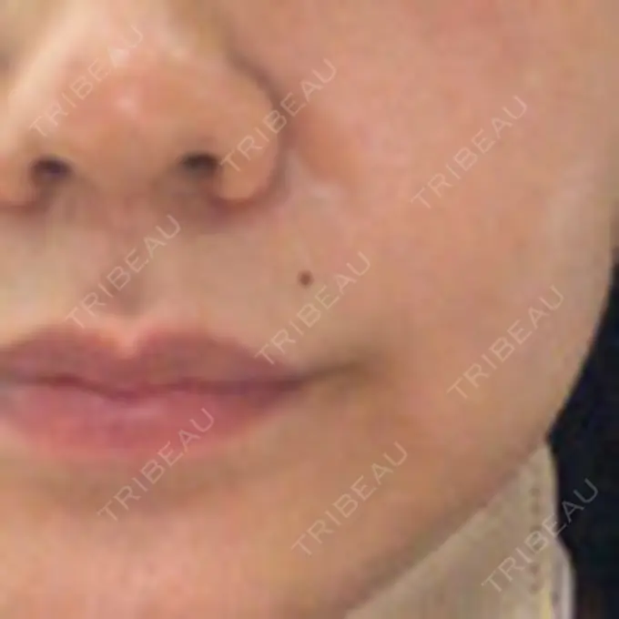 ほくろ・いぼ切除（肌） 吉祥寺アイビークリニック BEFORE メイン用