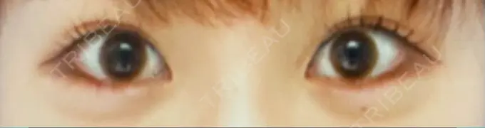 目尻切開 / タレ目形成・グラマラスライン（切開） / 目尻靭帯移動 BIOTOPE CLINIC 【ビオトープクリニック】 BEFORE メイン用