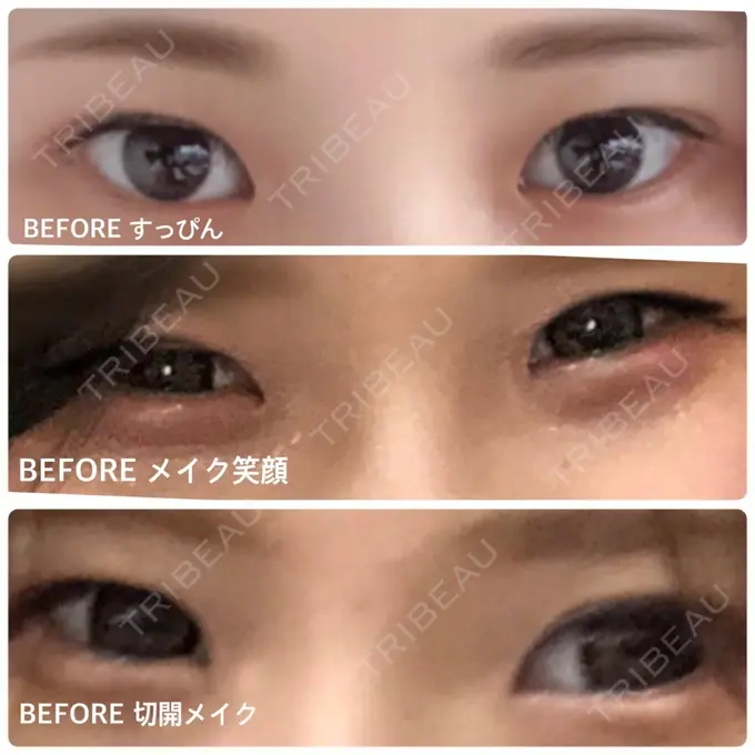 目頭切開 / 目尻切開 エートップ美容整形外科 BEFORE メイン用