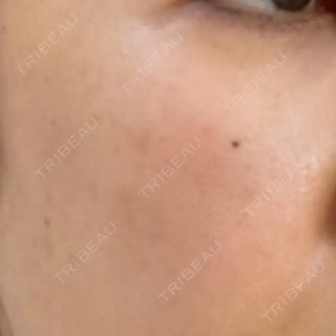 ピコレーザートーニング（美白・肝斑） design beauty clinic 梅田本院 BEFORE メイン用