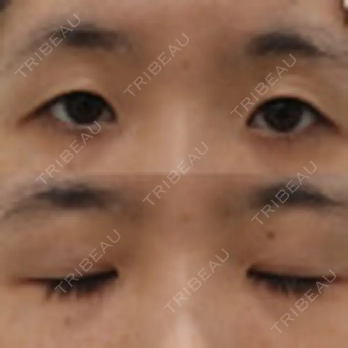 二重埋没 / 眼瞼下垂（非切開） WOM CLINIC GINZA （ワム クリニック ギンザ） BEFORE メイン用