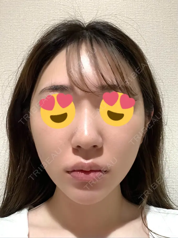 糸リフト / バッカルファット除去 大阪TAクリニック BEFORE メイン用