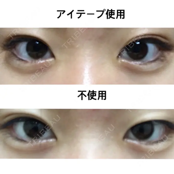 二重切開 みずほクリニック BEFORE メイン用