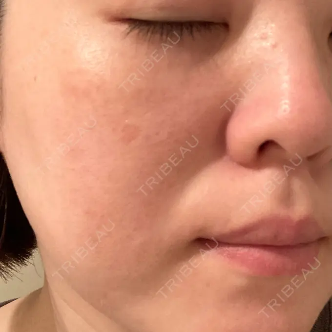 ピコレーザートーニング（美白・肝斑） フローラクリニック BEFORE メイン用